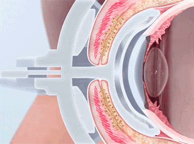 Animation showing a contact lens being inserted into an eye using a specialized applicator. The eyes anatomy, including the cornea, iris, and surrounding muscles, is visible as the lens is placed onto the eyes surface.