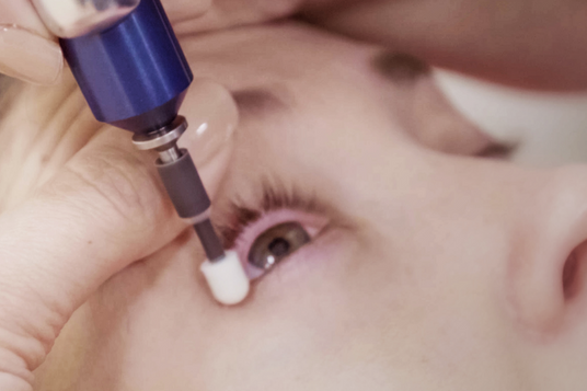 A close-up of a person undergoing an eyelid treatment. A tool with a white tip and blue handle is held near the persons open eye. The persons eyelashes and details of the eye are visible, with a focus on the tools application.