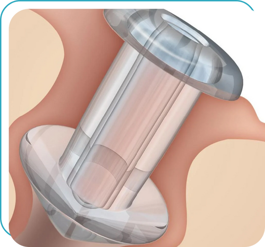 Illustration of a transparent dental or surgical guide placed on a gum-colored surface, showing a cylindrical guide sleeve with flanges at the top and bottom, designed to assist in accurate surgical procedures.