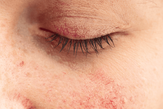 Close-up of a persons closed eye and cheek with visible skin redness and dryness. The eyelashes are black and the skin shows signs of texture and irritation.