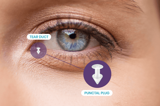 Close-up of a persons blue eye with text labels. A diagram shows tear duct near the inner corner of the eye and punctal plug with an illustration of the plug inserted into the duct.