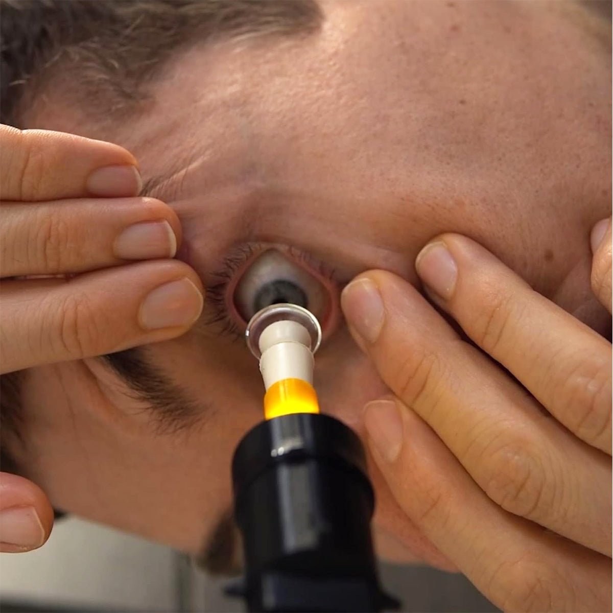 Using one hand to hold an eyelid open, a person carefully inserts the S5 Mini Inserter for Scleral & Hybrid Lens from Augmented Vision Labs into their eye. The orange-and-black tip aids precision, and free video training offers guidance for optimal comfort and effectiveness.