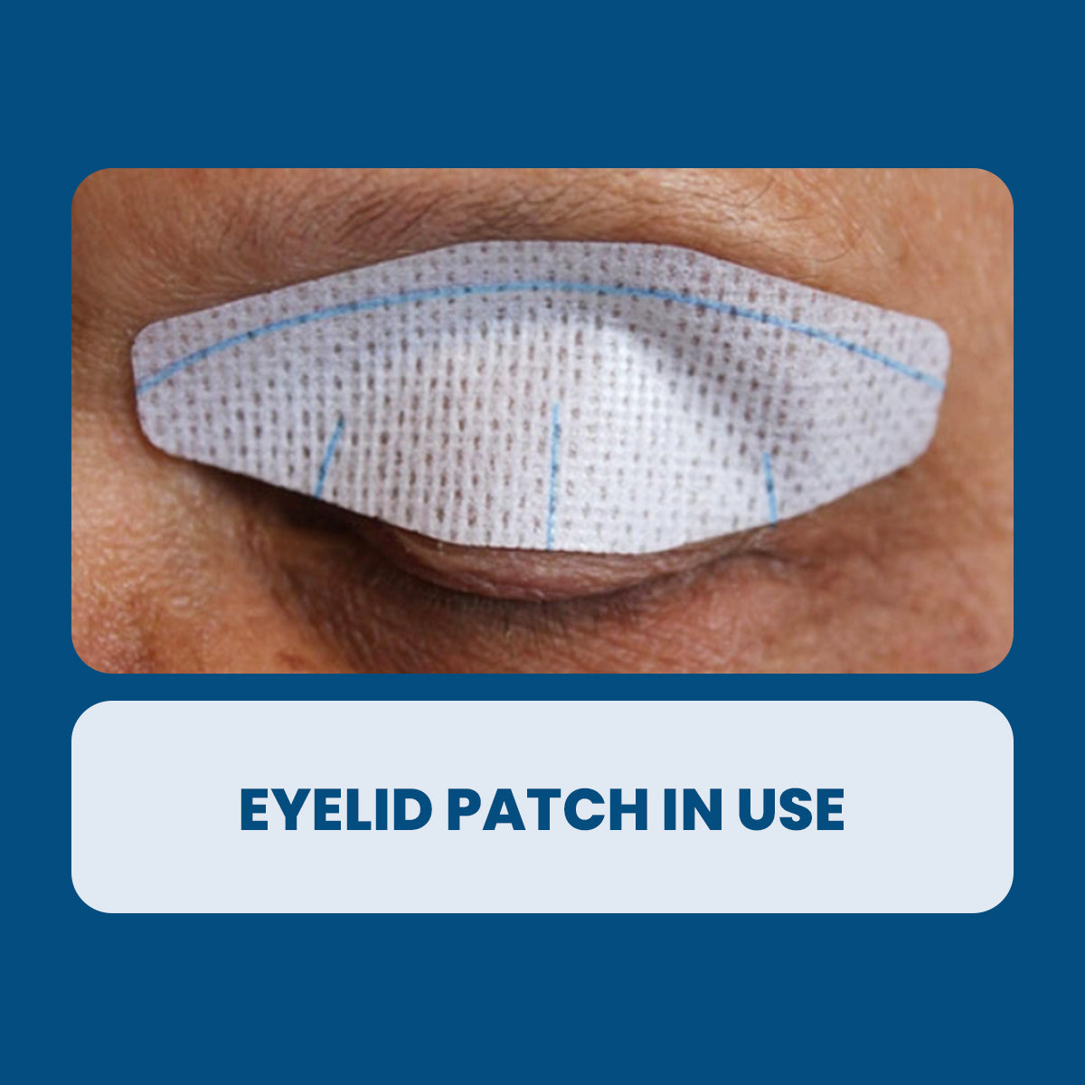 Close-up of a closed eye with the Nictavi Disposable Device for Nighttime Eye Lid Closure (15ct) applied. The patch provides dry eye relief and corneal protection with its textured surface and blue lines. Text below reads, Eyelid Patch in Use. The background is a solid blue color.