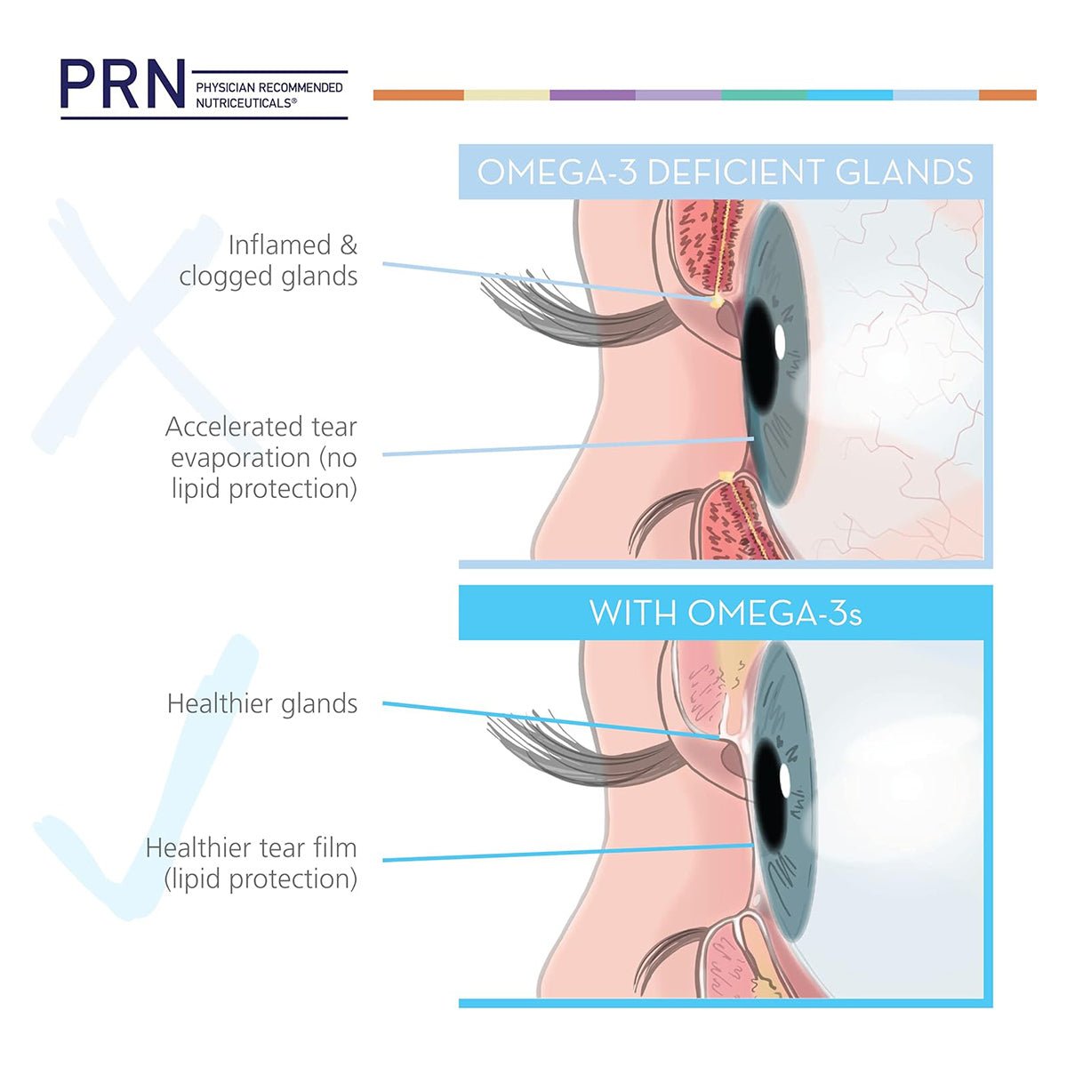 Illustration comparing eye glands: Top shows inflamed, clogged glands with rapid tear evaporation (lacking Omega-3s) affecting eye health. Bottom depicts healthier glands supported by PRN Eye Omega Benefits for Kids. Upper part has an X, lower a checkmark, highlighting importance for eye and brain health.