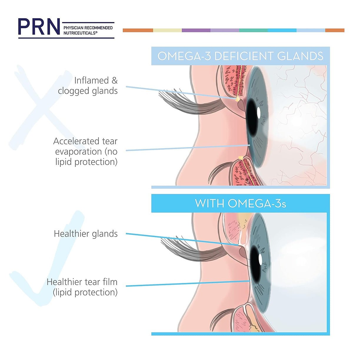 An illustration contrasts omega-3 deficient and enriched eyes: the top shows inflamed, clogged glands; the bottom reveals healthier glands and tear film post omega-3 intake. PRN DE3 Dry Eye Omega Benefits® offers relief through fish oil benefits.
