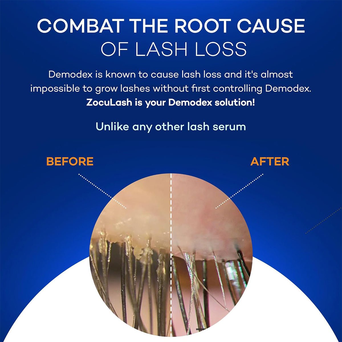 A split circle shows close-ups of eyelashes: less dense on the left, fuller and thicker on the right. Text above addresses Demodex-induced lash loss and highlights Zoculars ZocuLash Eyelash Enhancing Serum (2.5mL) with its Tripeptide Lash Complex for optimal lash health.