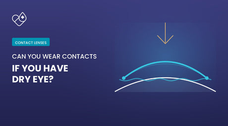 Line diagram of a contact lens curving above the eye surface