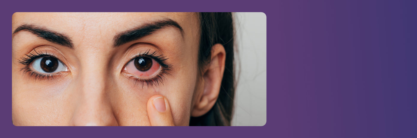 Close-up of a person with noticeable redness in one eye, gently pulling down the lower eyelid to reveal the irritation. The background is a gradient of purple.