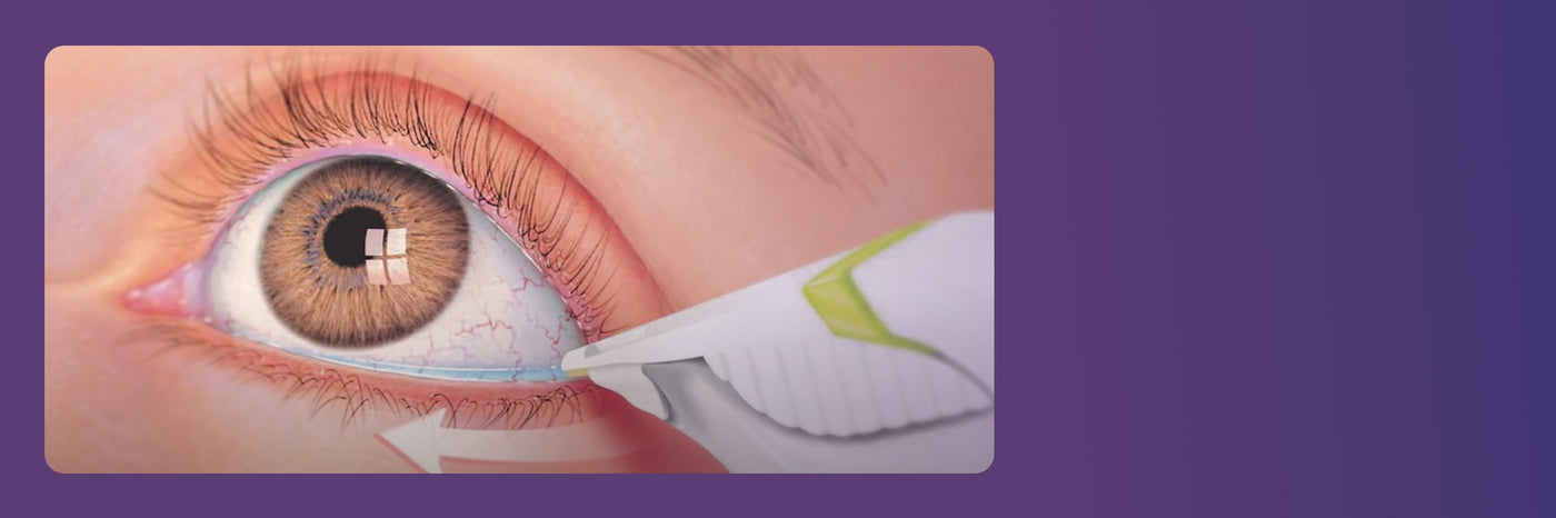 Illustration of an eye receiving an eye drop from a white and green bottle. The dropper is positioned above the lower eyelid, which is gently pulled down, exposing the lower part of the eye on a purple background.