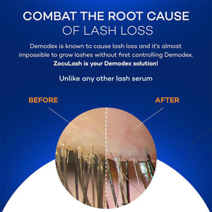 A split circle shows close-ups of eyelashes: less dense on the left, fuller and thicker on the right. Text above addresses Demodex-induced lash loss and highlights Zoculars ZocuLash Eyelash Enhancing Serum (2.5mL) with its Tripeptide Lash Complex for optimal lash health.